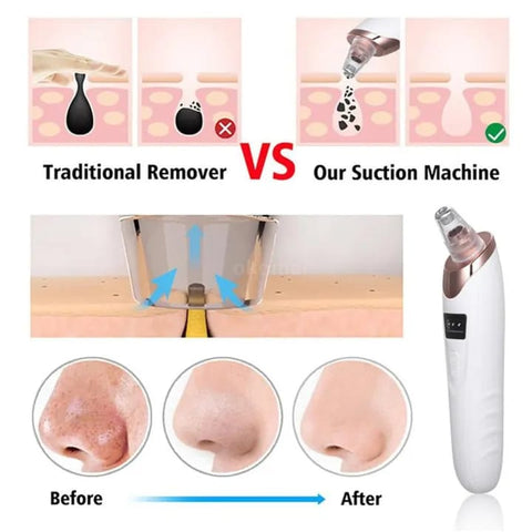 5-in-1 Blackhead remover, blackhead remover machine, derma suction, pimple acne remover.